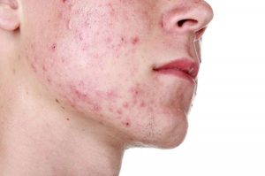 acne-giovanile